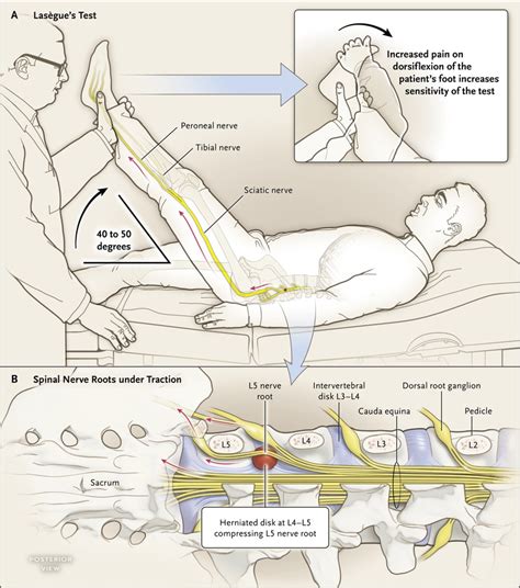 sciatica compression test|sciatic nerve pain physical exam.